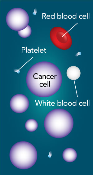 AML bone marrow